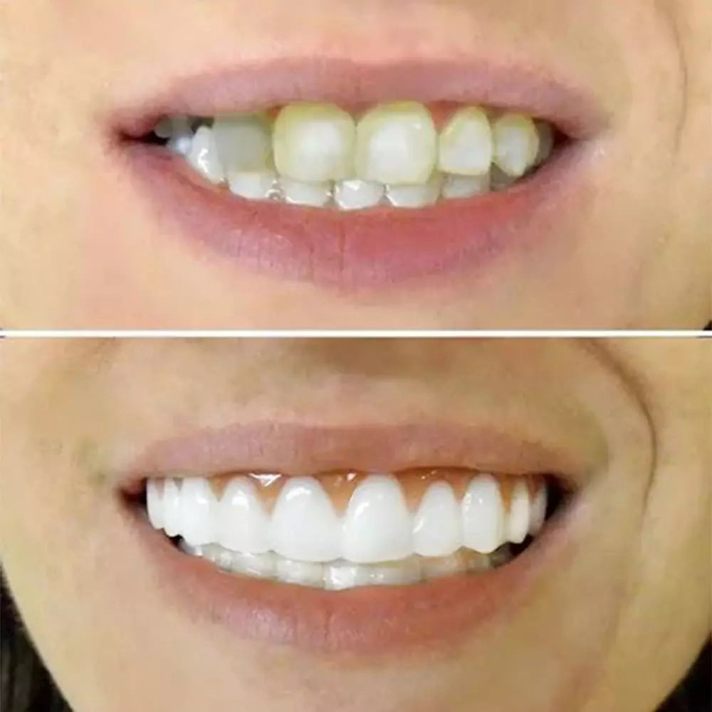 Dentadura Universal NewSmile